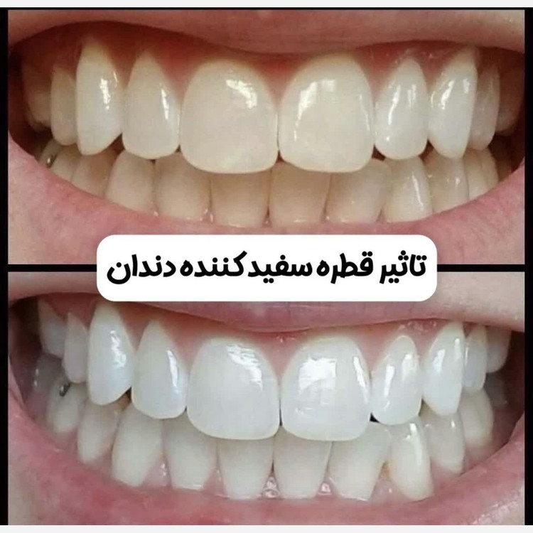 سفید کننده و جرم گیری دندان فوری لانبنا، رفع لک های ناشی از سیگار چای قهوه