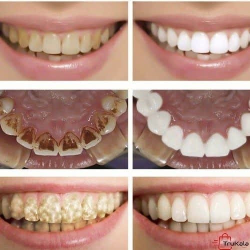 سفید کننده و جرم گیری دندان فوری لانبنا، رفع لک های ناشی از سیگار چای قهوه